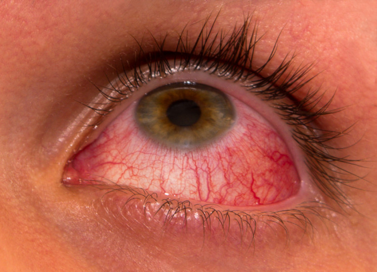 Inilah Penyebab Mata Merah dan Bagaimana Cara Mengatasinya?? – dara.co.id